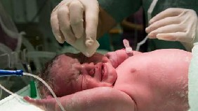 Negligencia obstetricia o parto